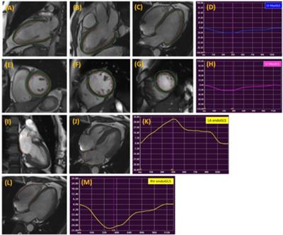 Normal Values of Myocardial Deformation Assessed by Cardiovascular Magnetic Resonance Feature Tracking in a Healthy Chinese Population: A Multicenter Study